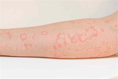 Pictures of Hives (Urticaria) to Help Identify a Skin Rash
