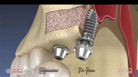 Dental Bone Graft Vs Sinus Lift At Joseph Park Blog