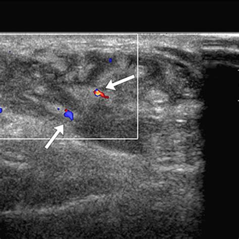 A Targeted Ultrasound Evaluation Of The Soft Palpable Mass Located Download Scientific Diagram