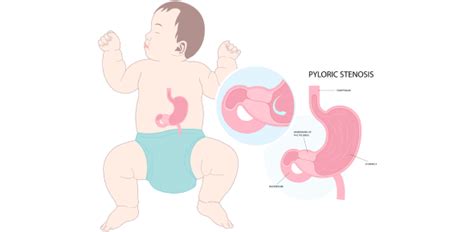 Is Your Baby Suffering From Silent Reflux? Take the Quiz. - ProProfs Quiz