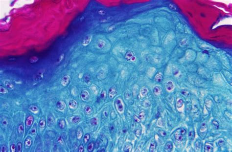 Monkeypox Could Soon Spread Beyond Gay And Bi Men Says WHO