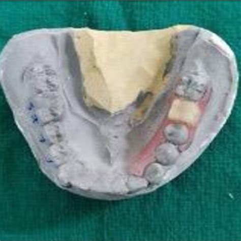 Impression Of Mandibular Arch Download Scientific Diagram