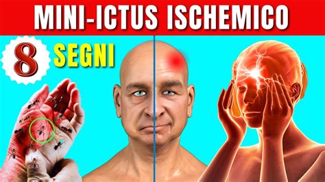 Segni Di Mini Ictus Ischemico Attacco Ischemico Transitorio Youtube