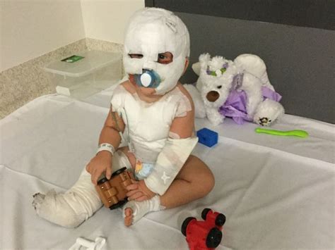 ‘screaming Mums Heartbreak Over Burnt Babys Nightmares The