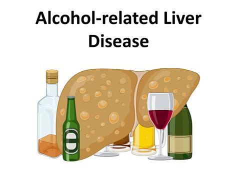 Alcohol-related Liver Disease - teachIM