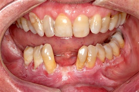 Proliferative Verrucous Leukoplakia