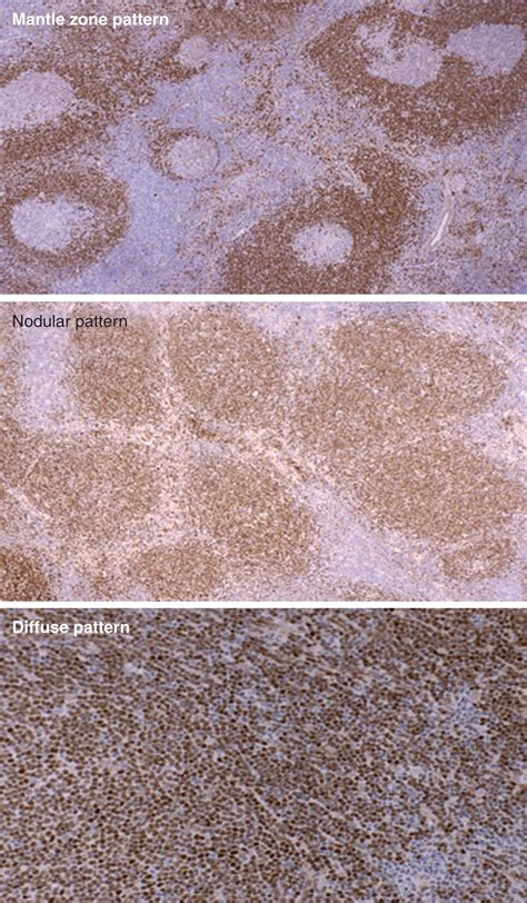 Mantle Cell Lymphoma Clinical Tree