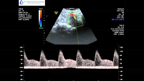 Ecografía Obstétrica Doppler de Arterias Uterinas YouTube