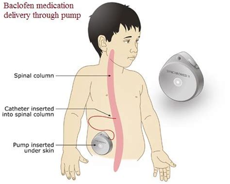 Baclofen Pump to help with Spasticity in Cerebral Palsy - Birth Advocacy