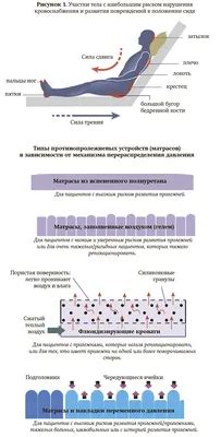 [41+] Пролежни фото