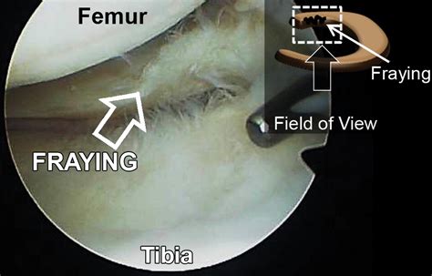 Mr Imagingbased Diagnosis And Classification Of Meniscal Tears