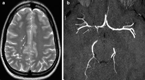 of Intracranial Atherosclerosis | Radiology Key