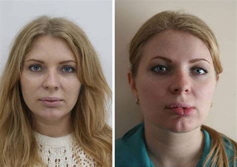 8 Bad Plastic Surgery Duck Lips Pics Plastic Surgery Magazine