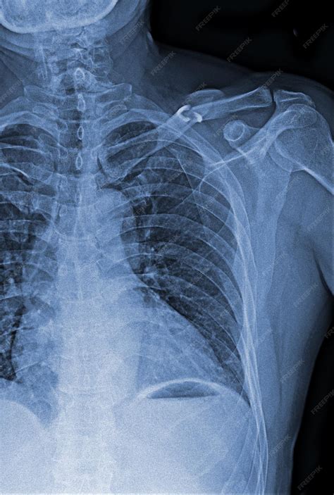 Premium Photo | A chest xray shows a chest xray with the left side of
