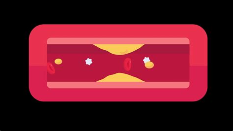 Atherosclerosis with high cholesterol Causes high blood fat and clogs