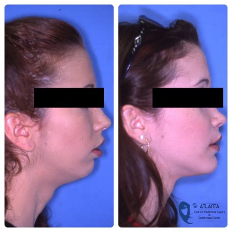 Jaw Surgery Alpharetta Ga Corrective Jaw Surgery