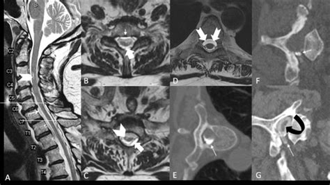 Sagittal A And Axial B D T W Spine Mri Showing Extra Arachnoid