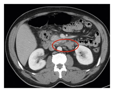 CT scan after initial presentation of acute pancreatitis. | Download Scientific Diagram