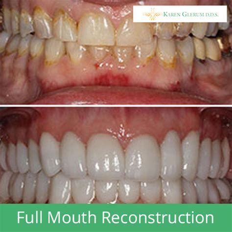 Full Mouth Reconstruction Cost Dental News Network