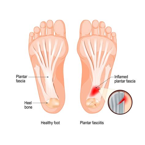 Treating Plantaris | Trigger Point Release | Knee Pain | Calf Pain | F