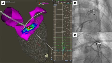 Intramural Needle Ablation For Refractory Premature Ventricular