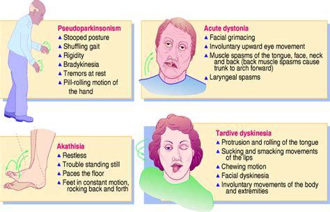 How I Treat Tardive Dyskinesia Psych Mental Health Hub