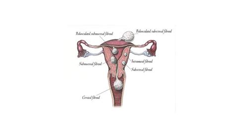 Vaginal Myomectomy Surgeon In Uae Fibroid Expert In Uae Dr Alphy S