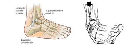 Esguince Del Ligamento Lateral Externo Del Tobillo