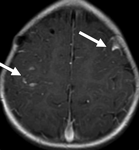 Imaging Of Metastatic Cns Neuroblastoma Ajr