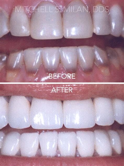 before-tetracycline-stained-teeth-after-corrected-porcelain-veneers ...