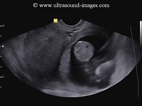 Ultrasound Images Of Early Pregnancy