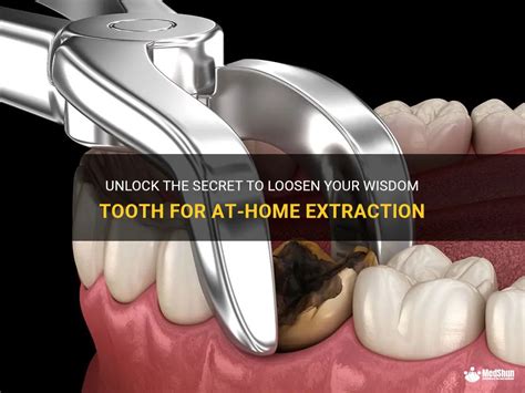 Unlock The Secret To Loosen Your Wisdom Tooth For At Home Extraction