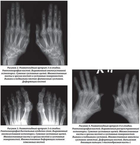 Подагрический Артрит Кистей Рук И Стоп — Buy-artox.ru