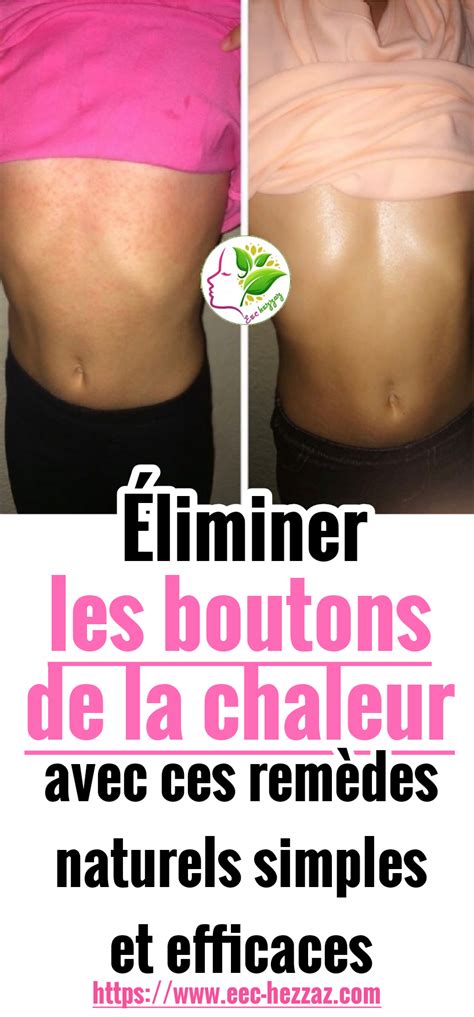 Éliminer les boutons de la chaleur avec ces remèdes naturels simples et