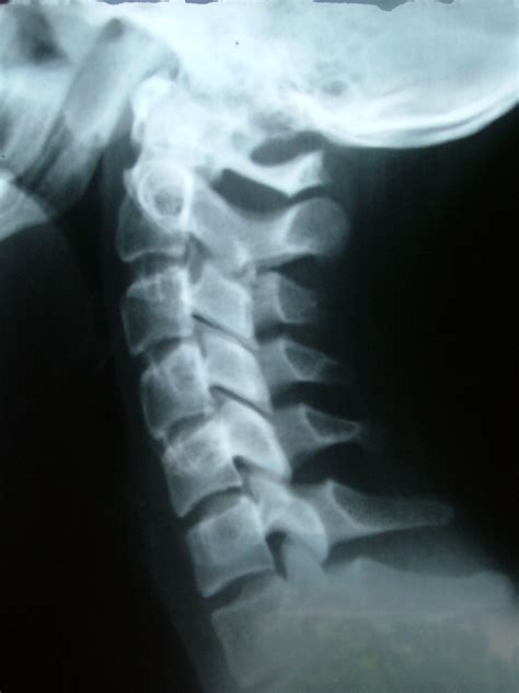 Osteoarthritis Neck