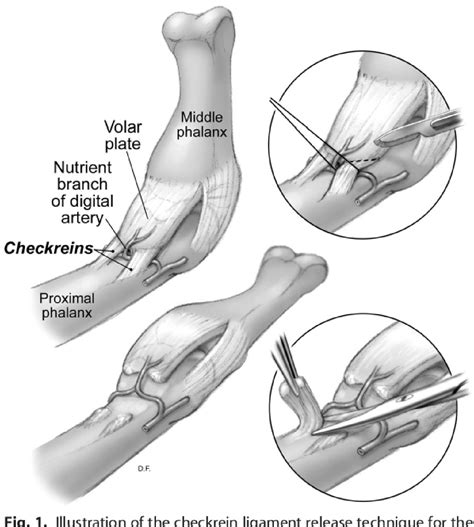 Ligament Hyperlaxity at Rebecca Bowens blog
