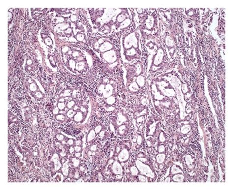 Morphologic Features Of Lung Adenocarcinoma According To The