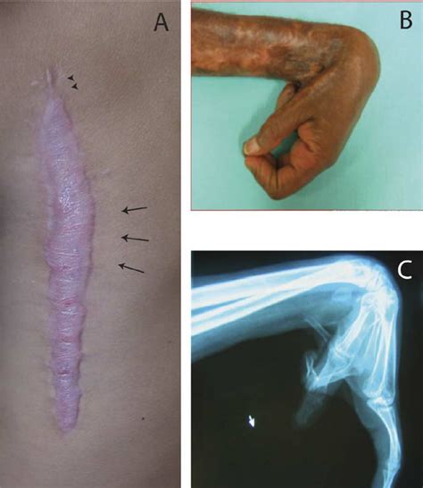 Complications Of Hypertrophic Scarring Download Scientific Diagram