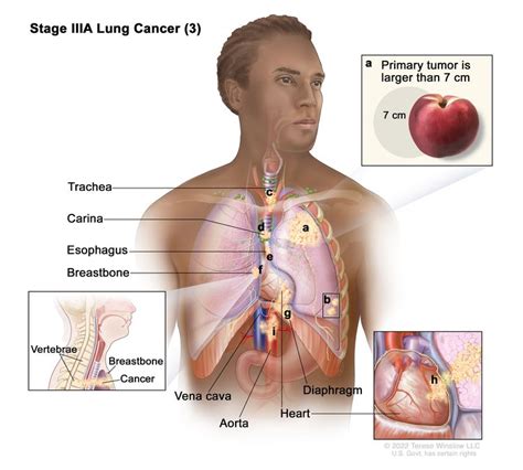 Non-Small Cell Lung Cancer Treatment - NCI