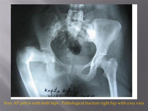 PPT Fibrous Dysplasia With Pathological Fracture Of Proximal Femur In