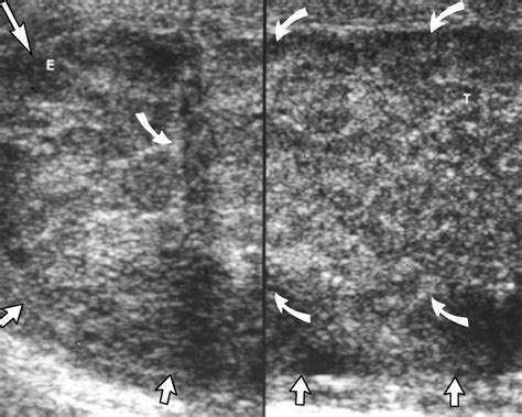 Tuberculous Epididymitis And Epididymo Orchitis Sonographic Appearances