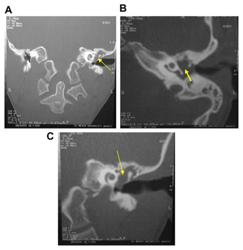 Left Attico Antral Cholesteatoma High Resolution Ct Examination Of The