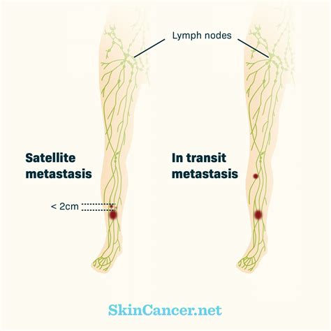 Skin Cancer In Lymph Nodes