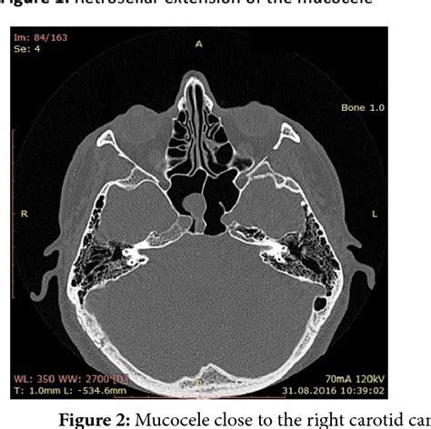 Figure 2 From The Endoscopic Approach Of The Sphenoid Sinus Mucocele A Case Report Semantic