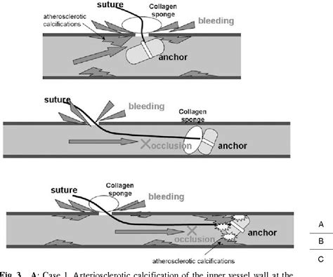 Figure 3 From Surgical Treatment Of Complications Associated With The