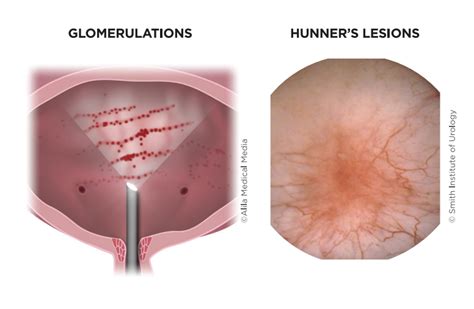 Interstitial Cystitis/ Bladder Pain Syndrome - Brazosport Women's Health