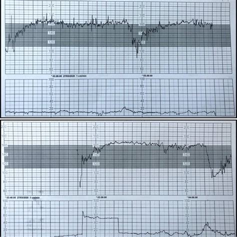 Illustrative Snapshot Of Fetal Heart Rate Tracing Tachycardia Absent Download Scientific