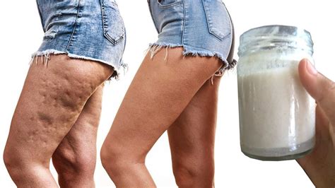 Adieu Les Cellulite Jusqua Jamais Eliminer Les En Appliquant Ceci