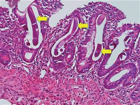 SciELO - Brasil - Strongyloides stercoralis hyperinfection: an unusual