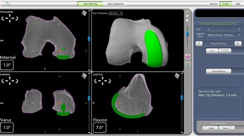 Makoplasty Singapore|Partial Knee Replacement|Faster Recovery